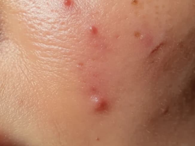 Close-up of acne-prone skin