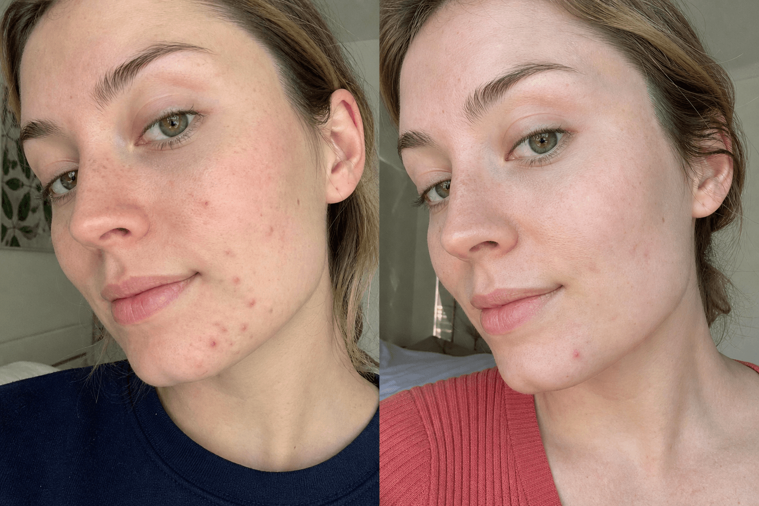 Maya's skin before and after using The Acne Solution