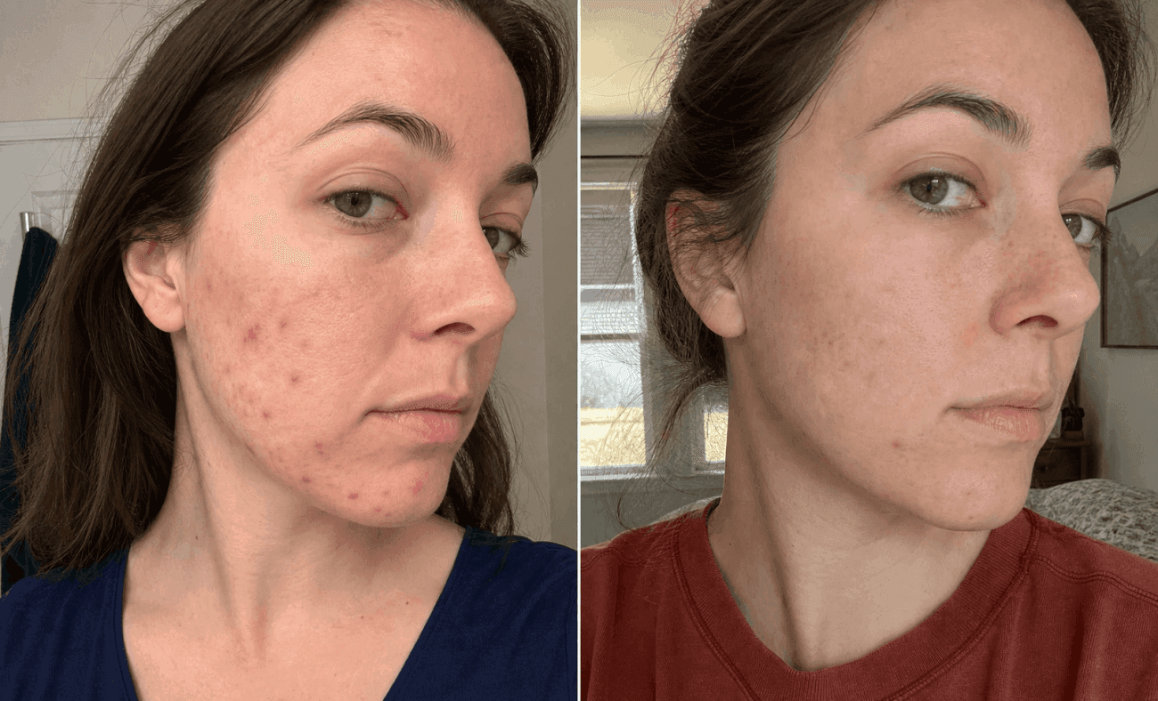 Rachel's skin before and after using The Advanced Acne Solution