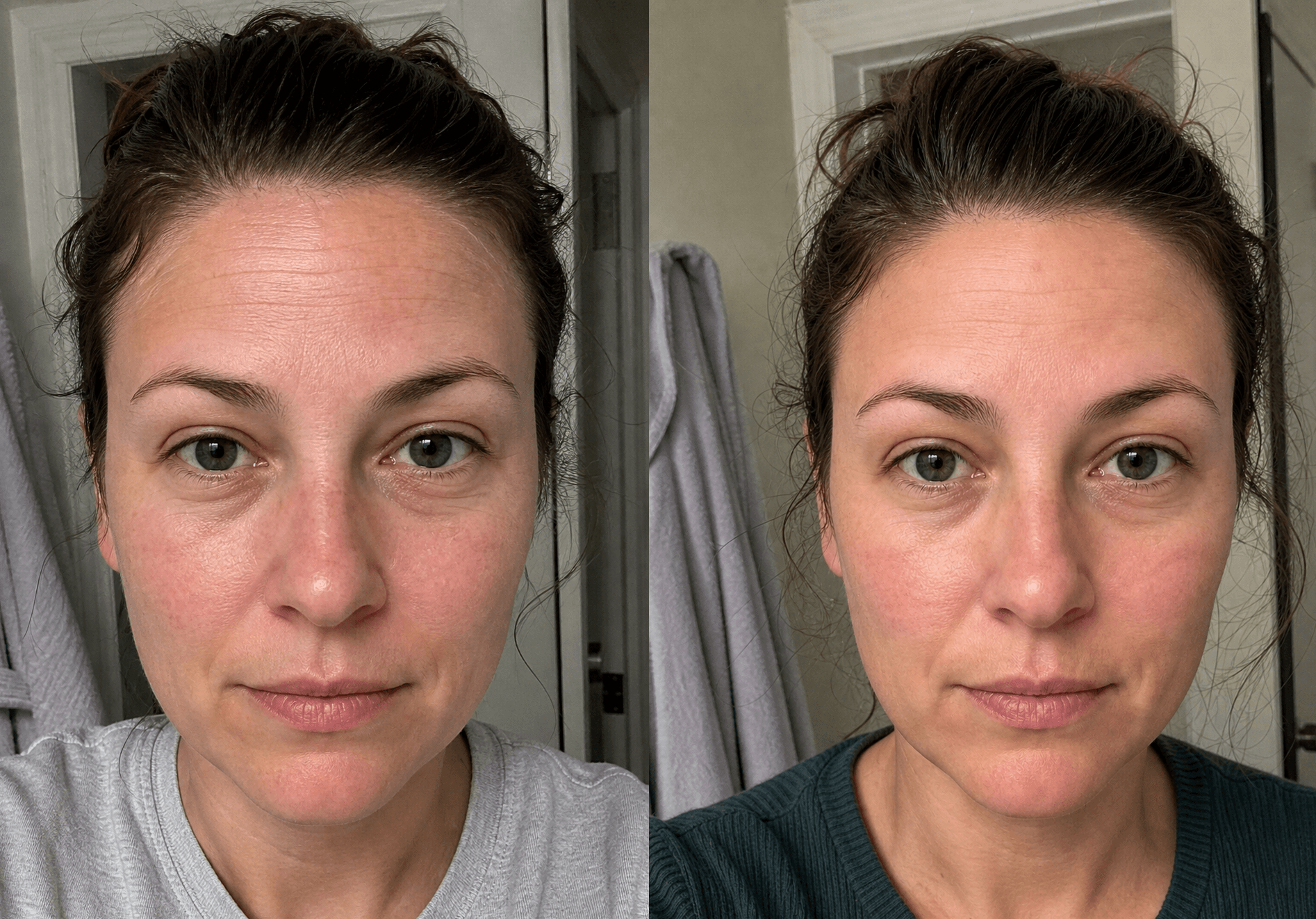 Emily's skin before and after using The Anti-Aging Solution