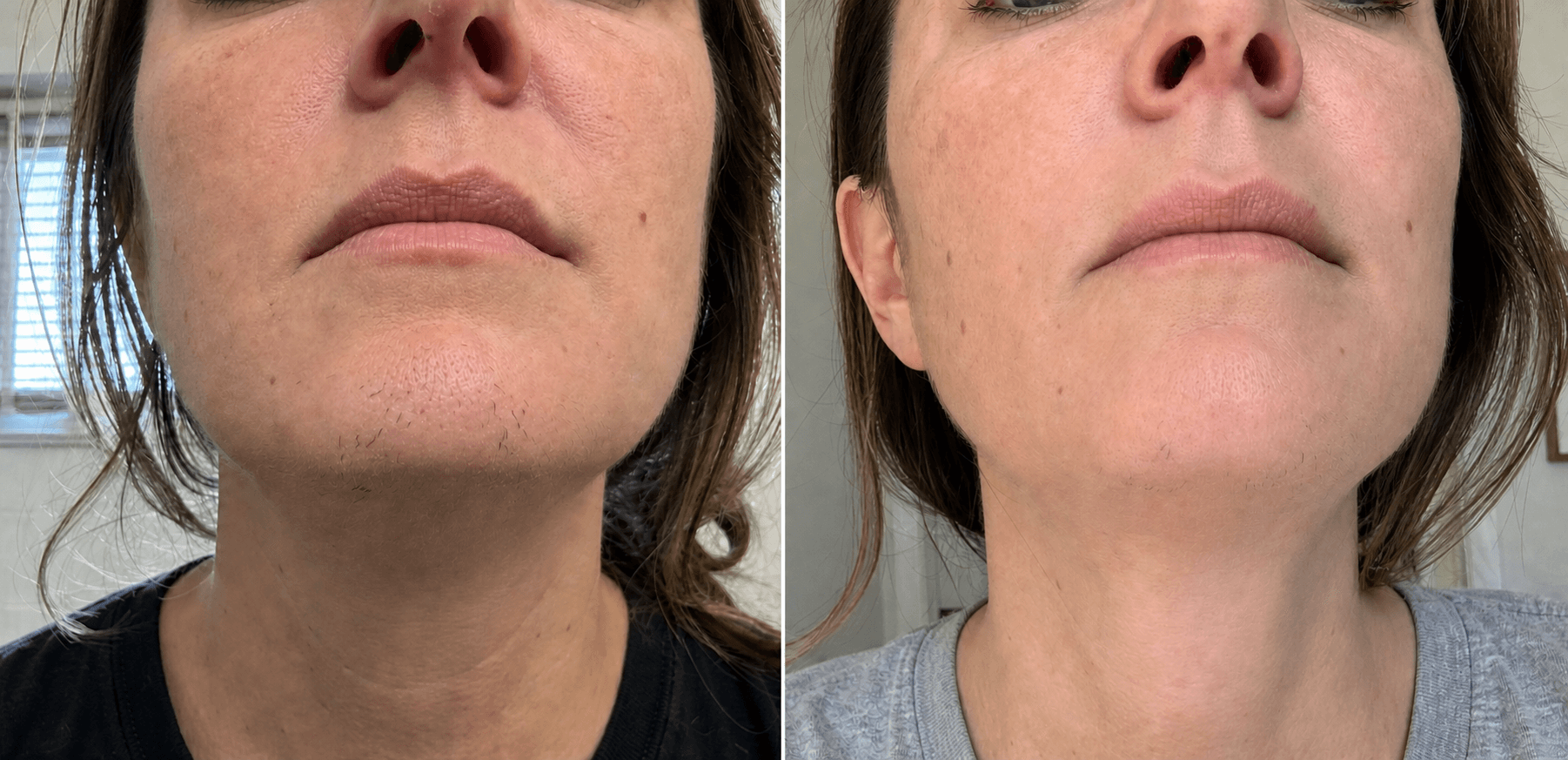 Monica's skin before and after using The Hair Reduction Solution