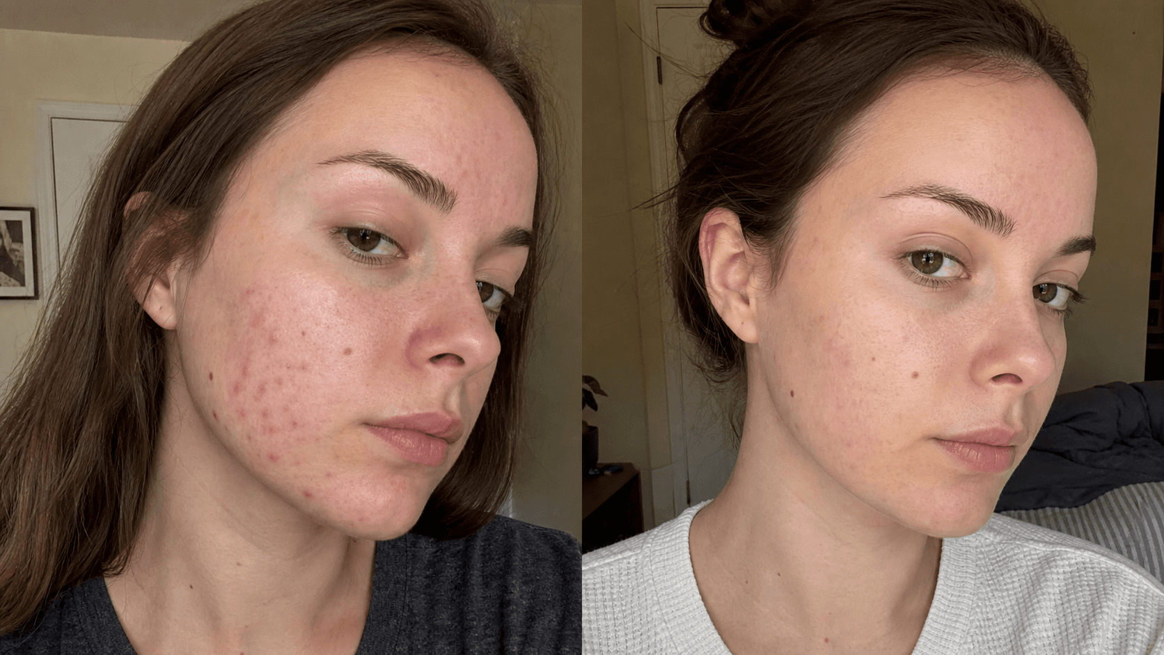 Madison's skin before and after using The Red Mark Solution