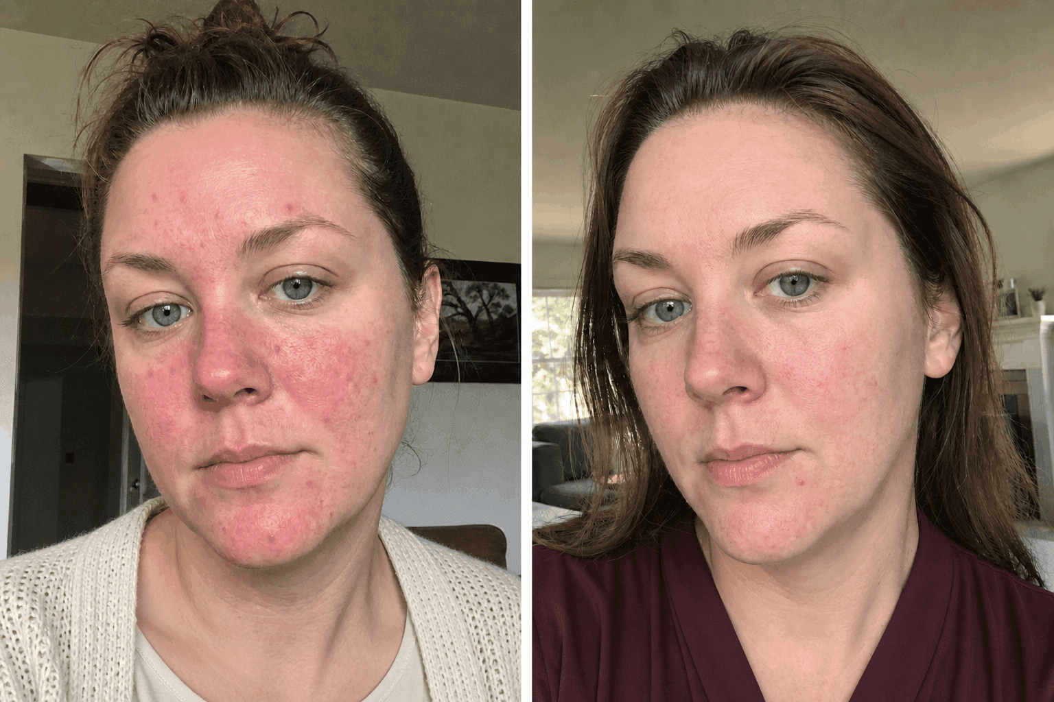 Hannah's skin before and after using The Advanced Redness Solution