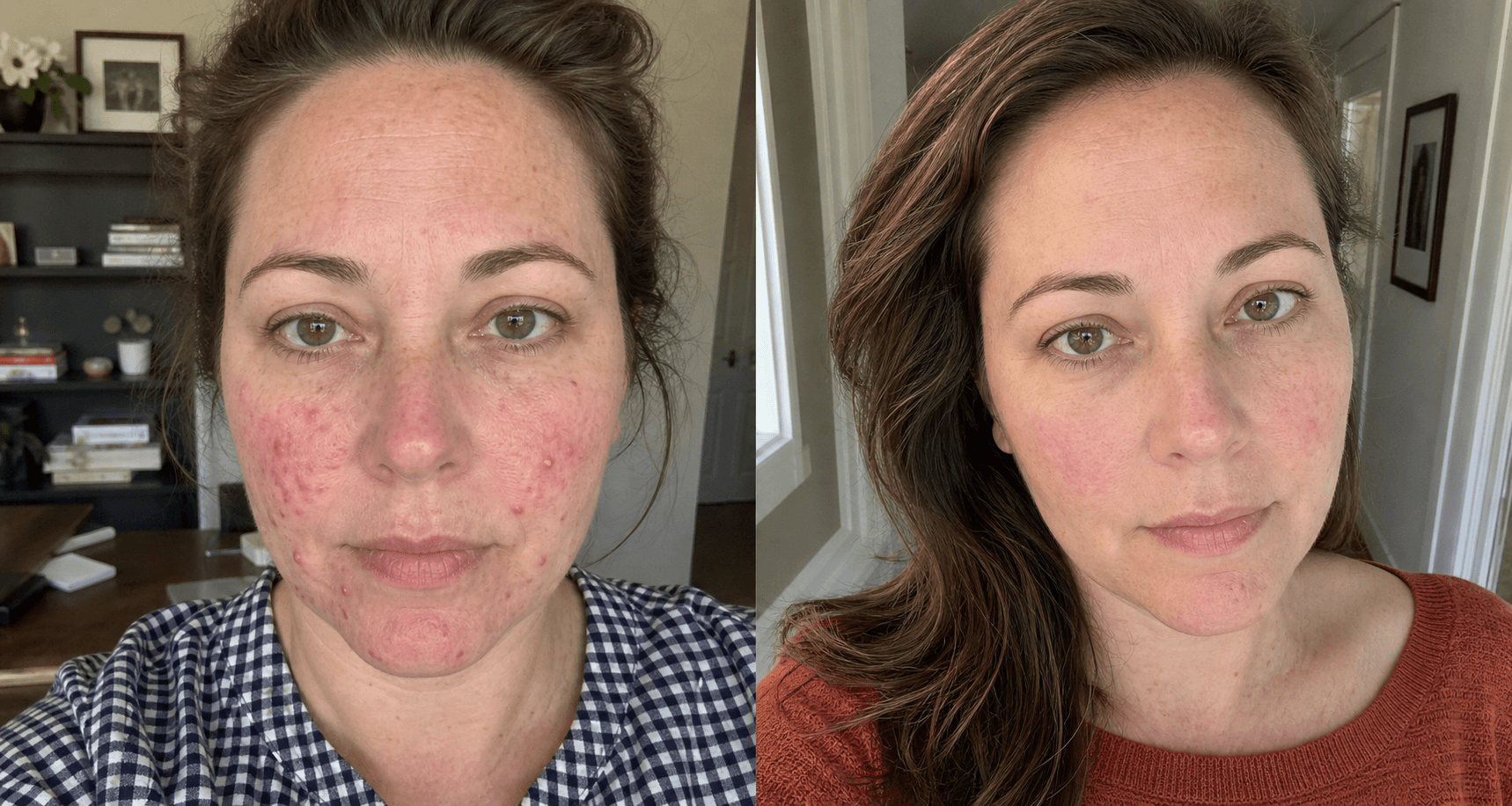 Mallory's skin before and after using The Clarifying Rosacea Formula