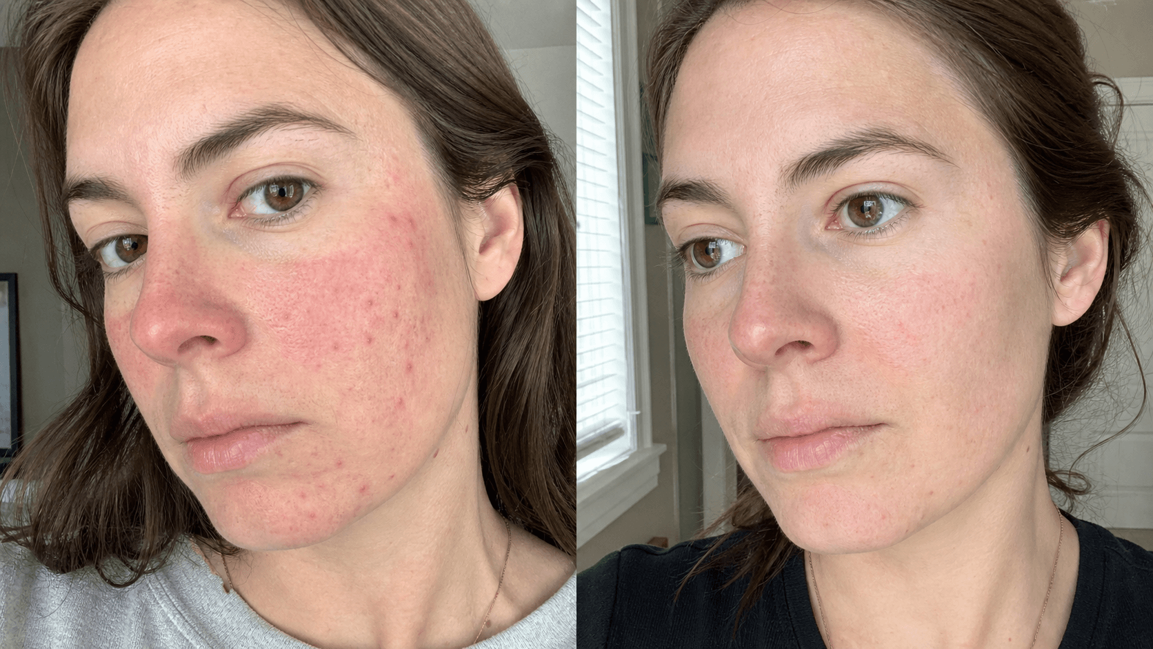Brooke's skin before and after using The Redness & Acne Formula