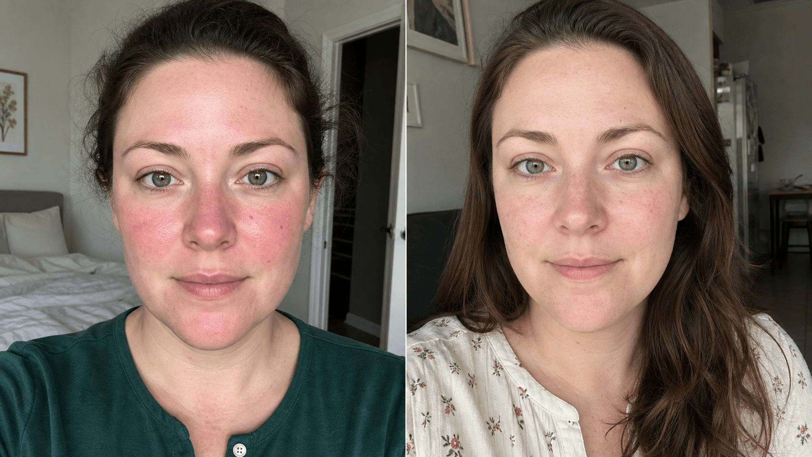 Celine's skin before and after using The Redness Control Formula